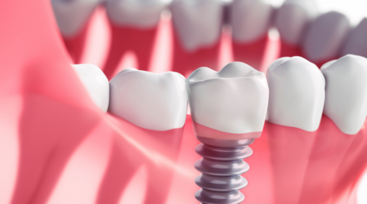 Dental Implants In Leicester
