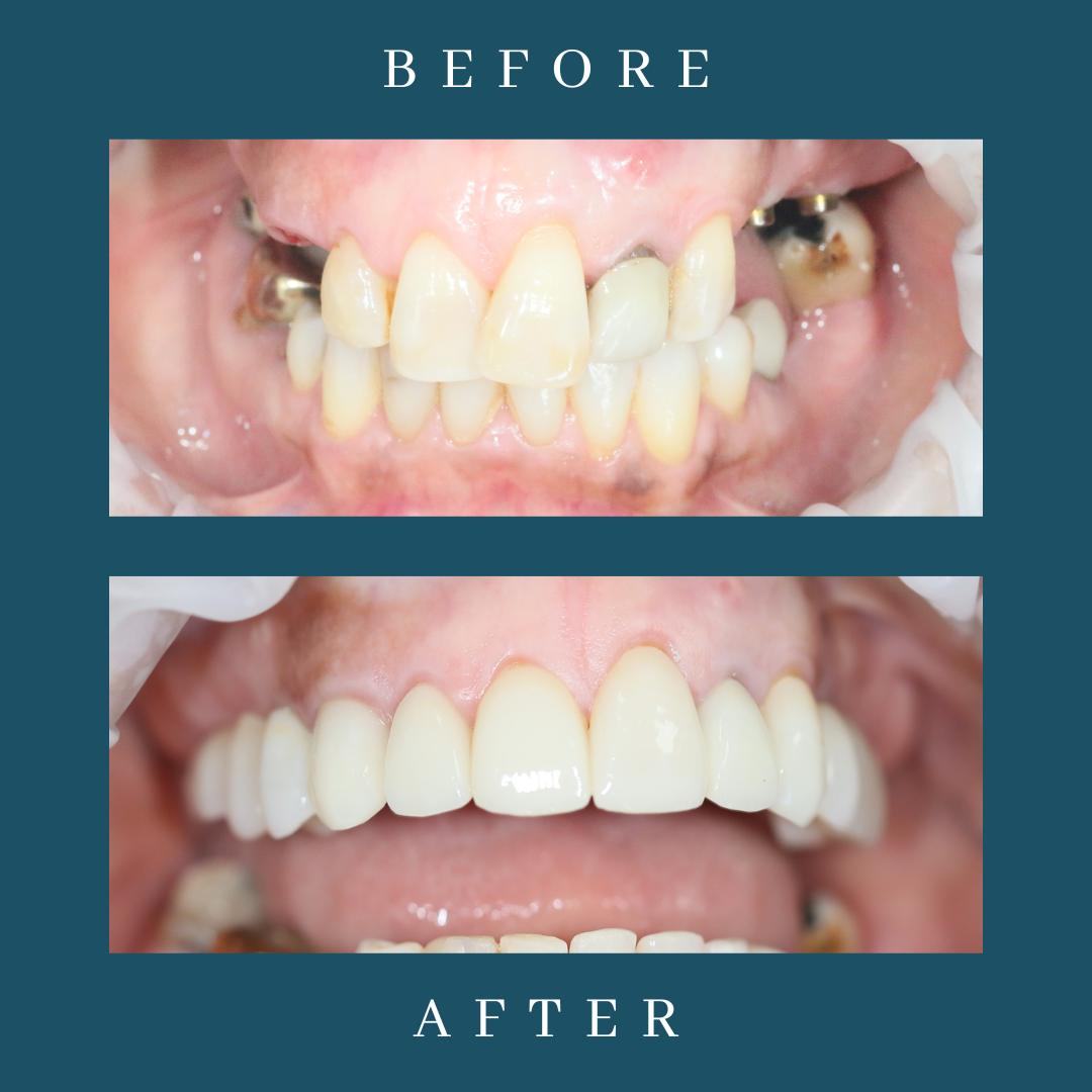 dental implants teeth in a day