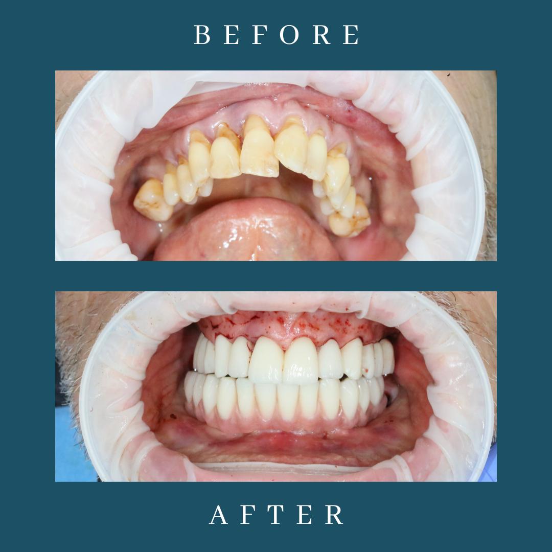dental implants teeth in a day